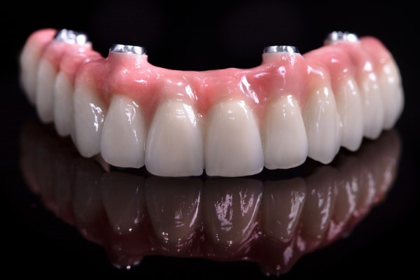 How All On 4 Dental Implants Can Replace All Your Top Teeth