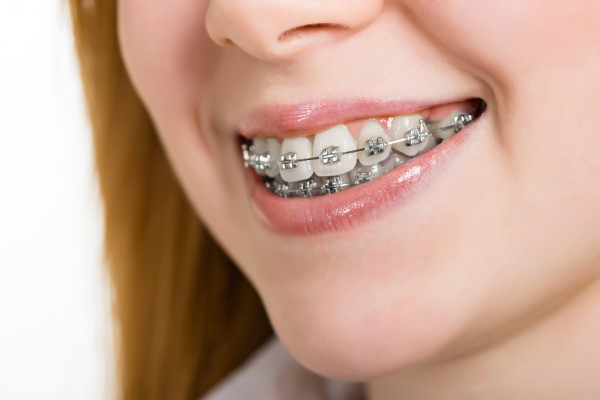 How Often Do Braces Need to Be Tightened?