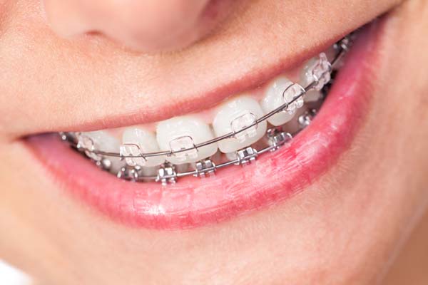 How Orthodontics Can Help With Teeth Straightening