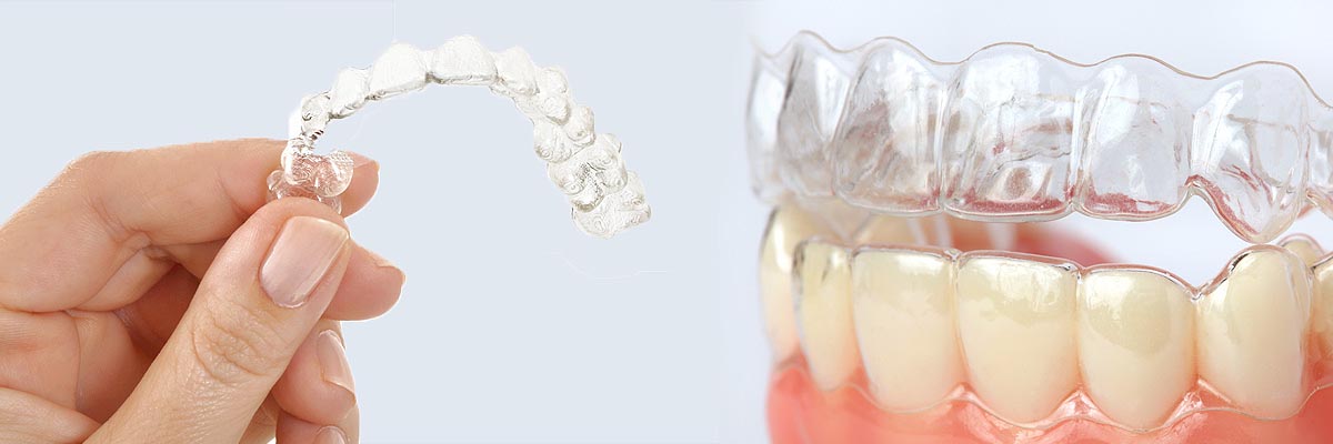 Common Clear Braces Maintenance and Aftercare