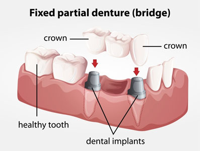 How Are Dental Bridges Installed?