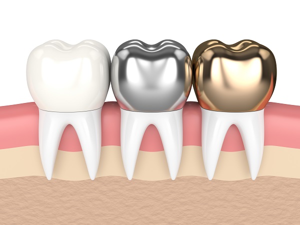 How a General Dentist Uses Crowns to Repair Teeth