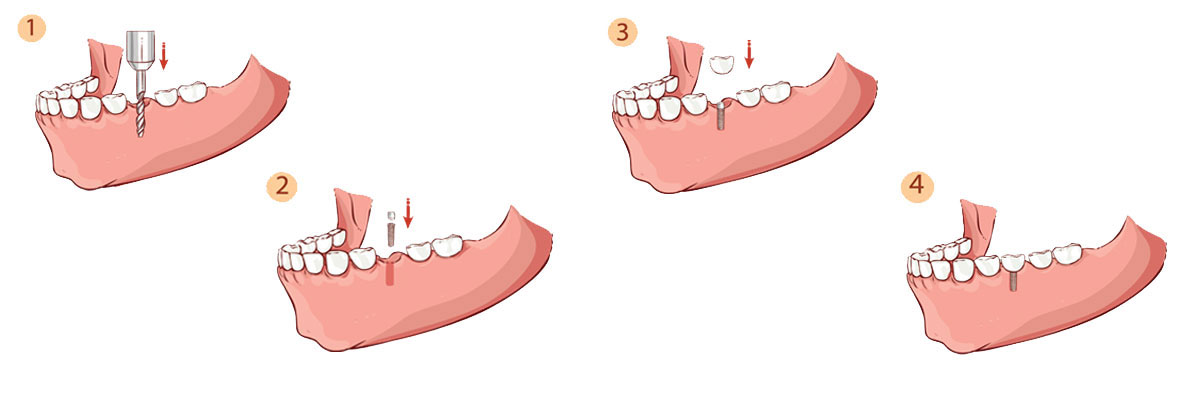 Dalton Dental Implant Restoration