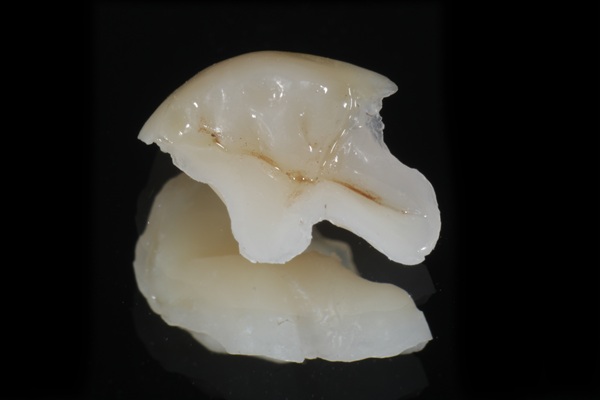 The Difference Between Dental Inlays And Dental Crowns