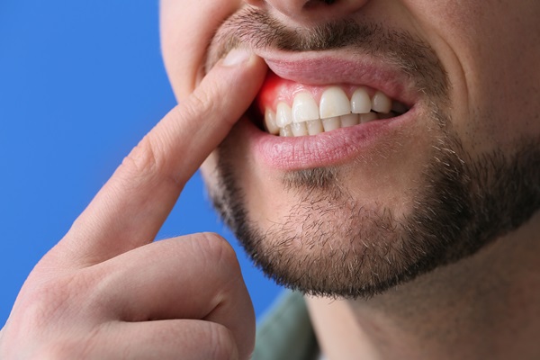 The Stages Of Gum Disease And When To Seek Treatment