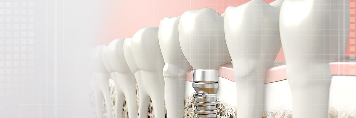 Dalton Implant Dentist