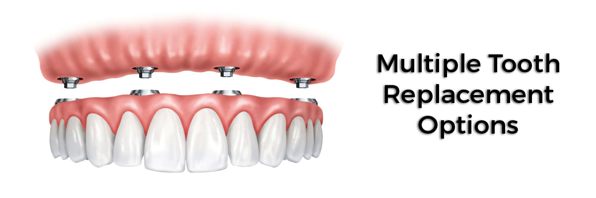 Dalton Multiple Teeth Replacement Options