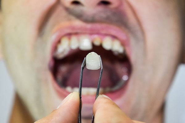 Options For Replacing Missing Teeth Dalton, GA