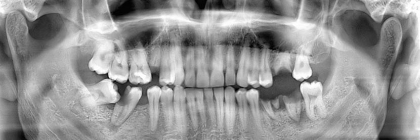 Панорамный снимок зубов фото Options for Replacing Missing Teeth Treatment Options Dalton, GA