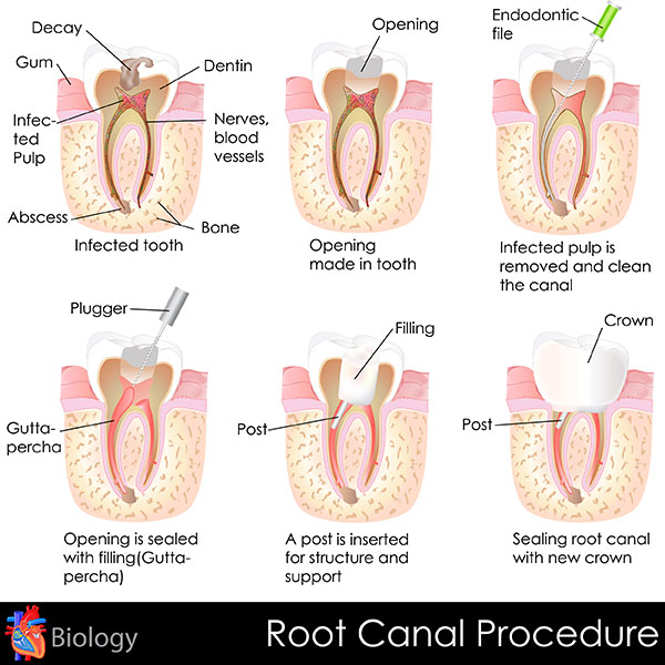 Faq S For Deciding Between A Root Canal Or Extraction