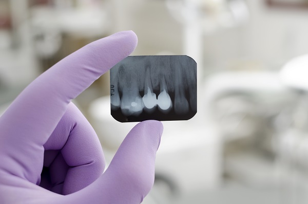 Digital Dentistry FAQs: X Rays